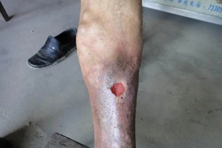 坏疽性臁疮小腿小坑图 坏疽性臁疮小腿小坑图