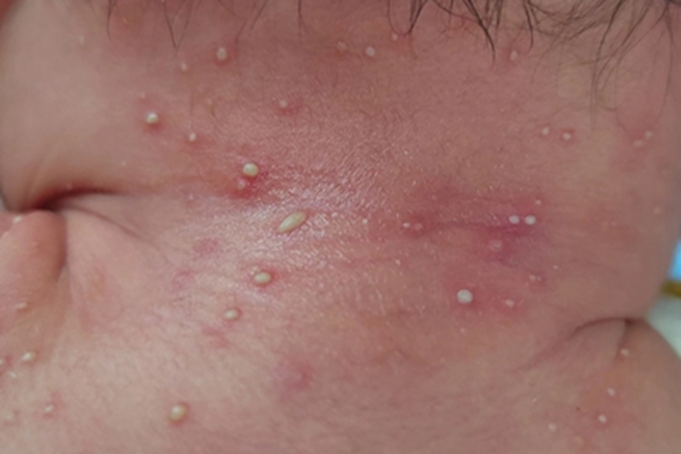 新生儿脓疱疮颈后散在脓疱图