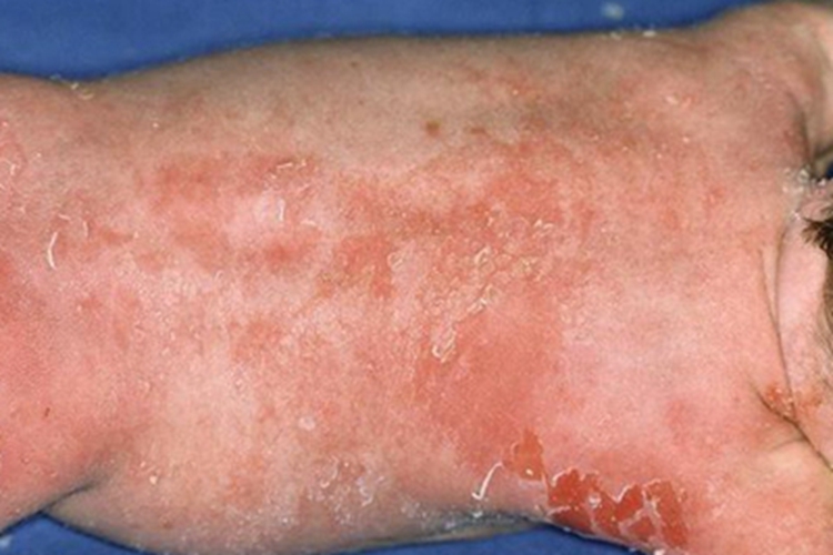 脓疱疮背部脱皮图