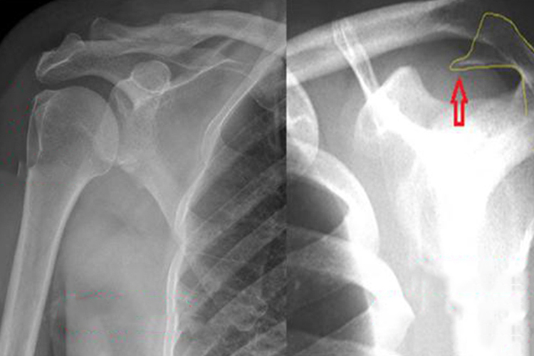 退行性肩关节炎影像图图 退行性肩关节炎影像图图