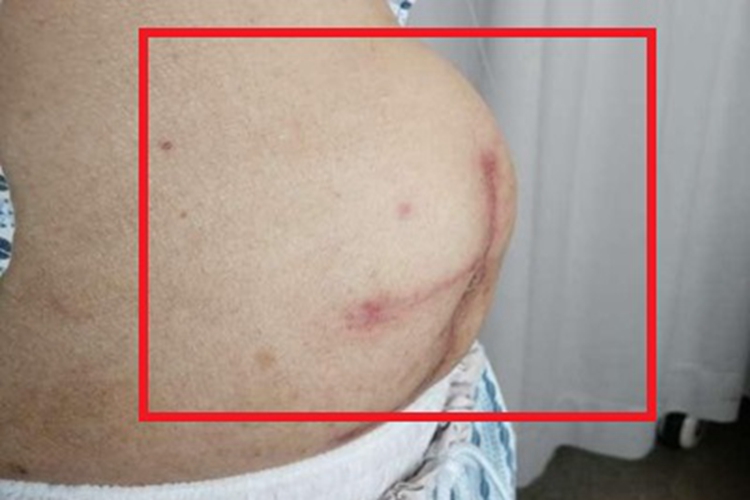 切口疝下腹症状图