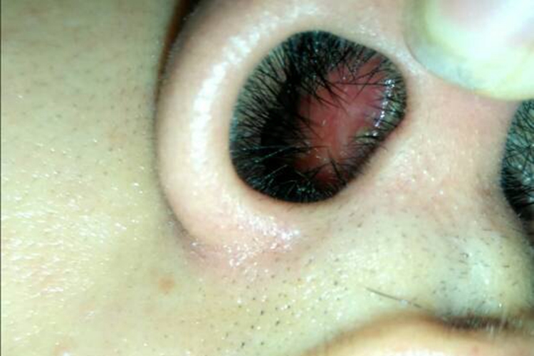 鼻腔鼻窦血管瘤图 鼻腔鼻窦血管瘤图