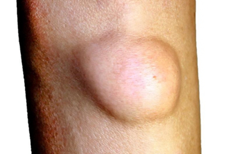 脂肪瘤胳膊上有一个大软包图