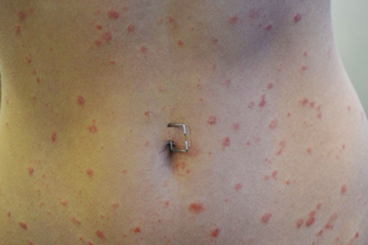 玫瑰糠疹丘疹图