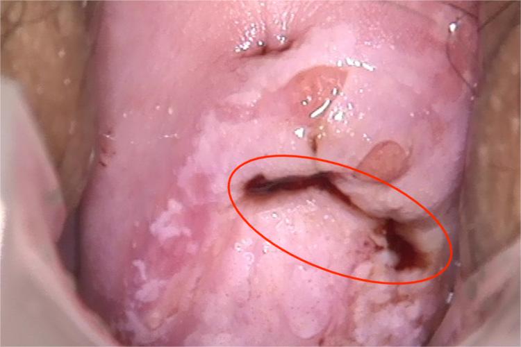 子宫颈癌褐色分泌物图