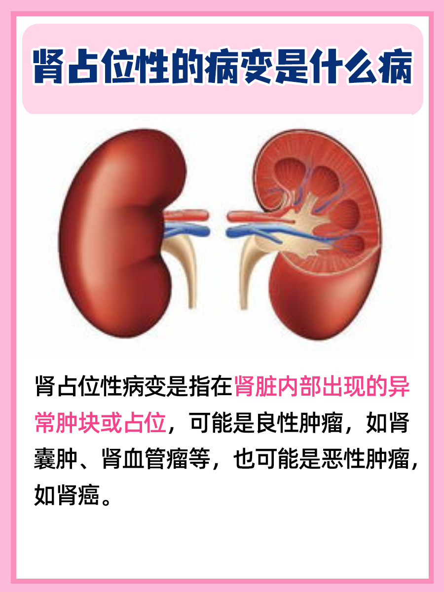 肾占位性病变：了解其含义与日常注意事项