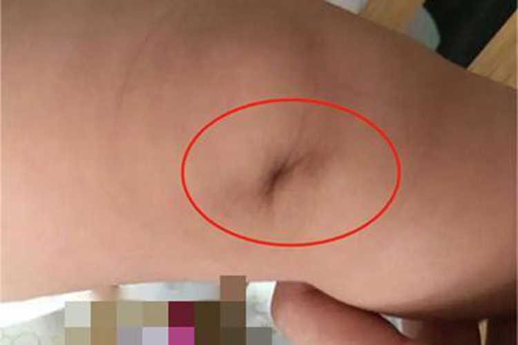 皮肤弹性过度膝盖小坑图