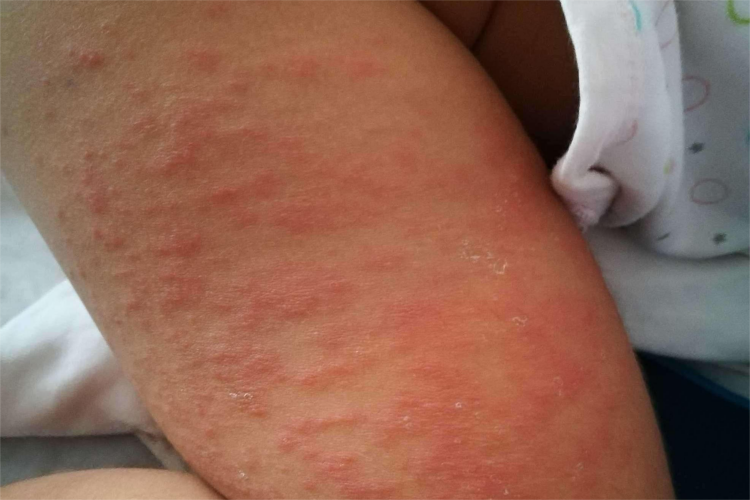 新生儿中毒性红斑图