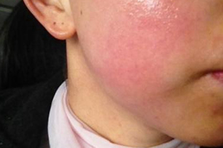 季节性接触性皮炎红肿图