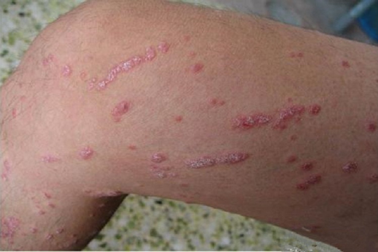 二期梅毒膝盖症状图