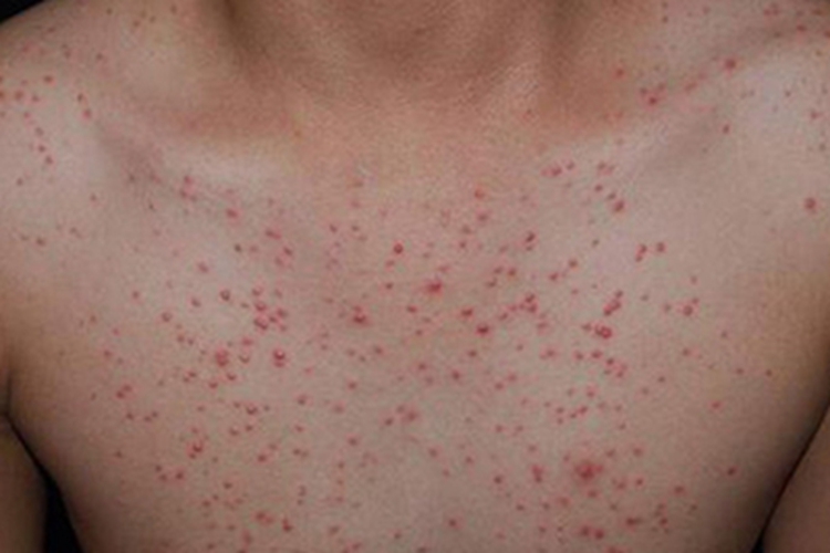 艾滋病感染性皮肤损害小红疙瘩图