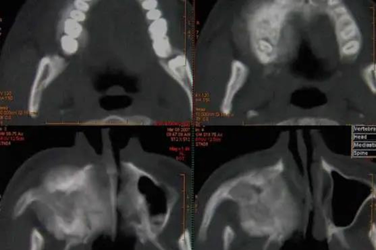 上颌骨骨肉瘤图