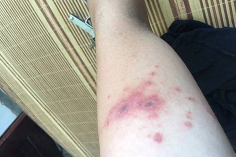 嗜酸性脓疱性毛囊炎胳膊症状图