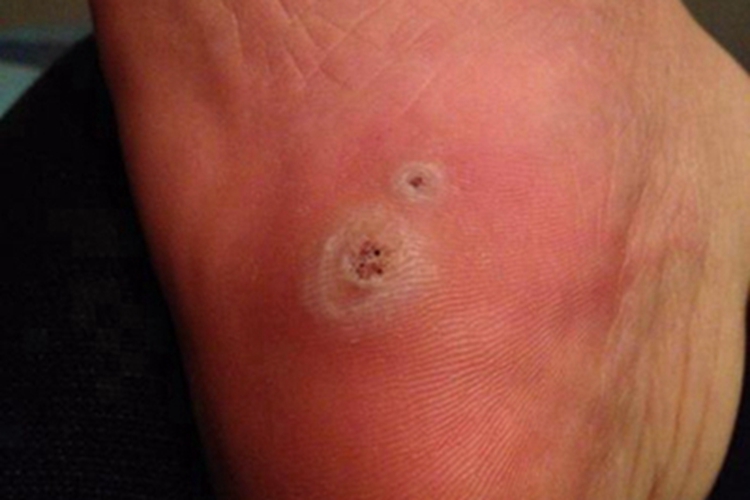 职业性疣赘脚底症状图