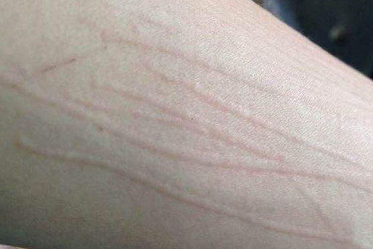 皮肤刮痕症早期图