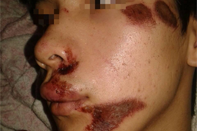 擦伤面部血痂图