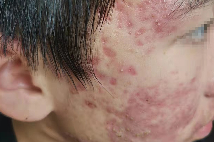 Ⅱ度痤疮图
