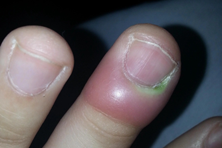 脓性指头炎手指红肿图 脓性指头炎手指红肿图