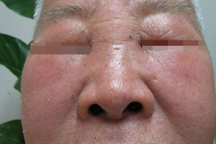 旋毛虫病面部水肿图