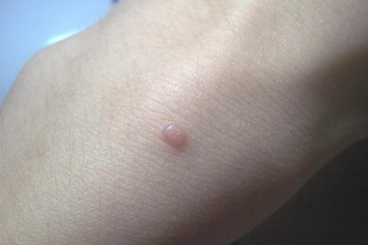 皮肤黏液瘤手腕疙瘩图 皮肤黏液瘤手腕疙瘩图