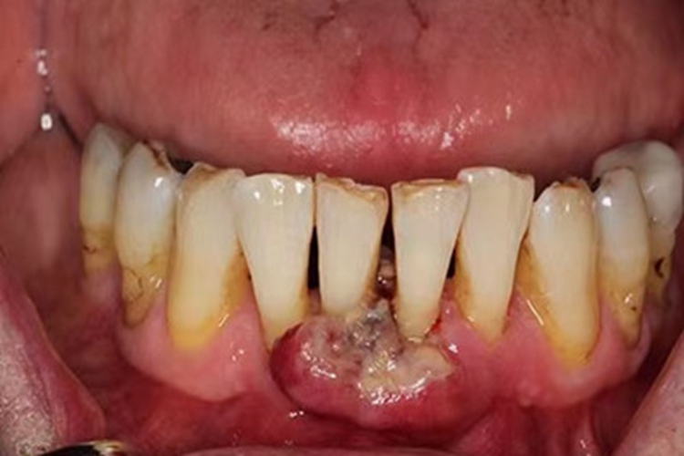 牙龈癌早期溃疡图