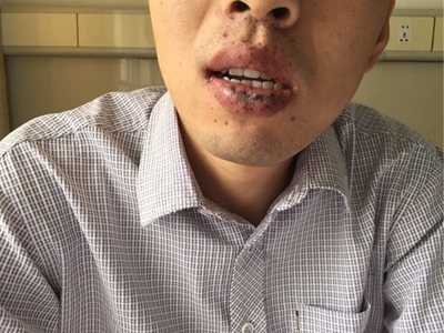 色素沉着息肉综合征嘴唇周围黑色斑点图