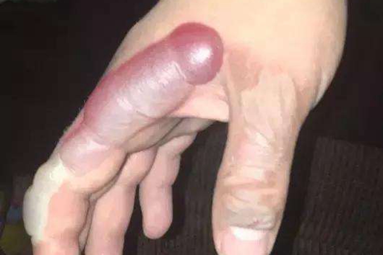 手指肿且有瘀血图 手指肿且有瘀血图