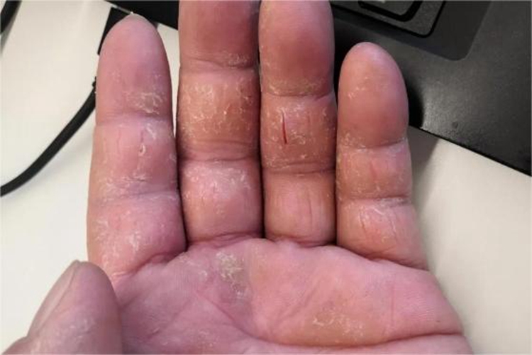 皲裂性湿疹手指裂口图