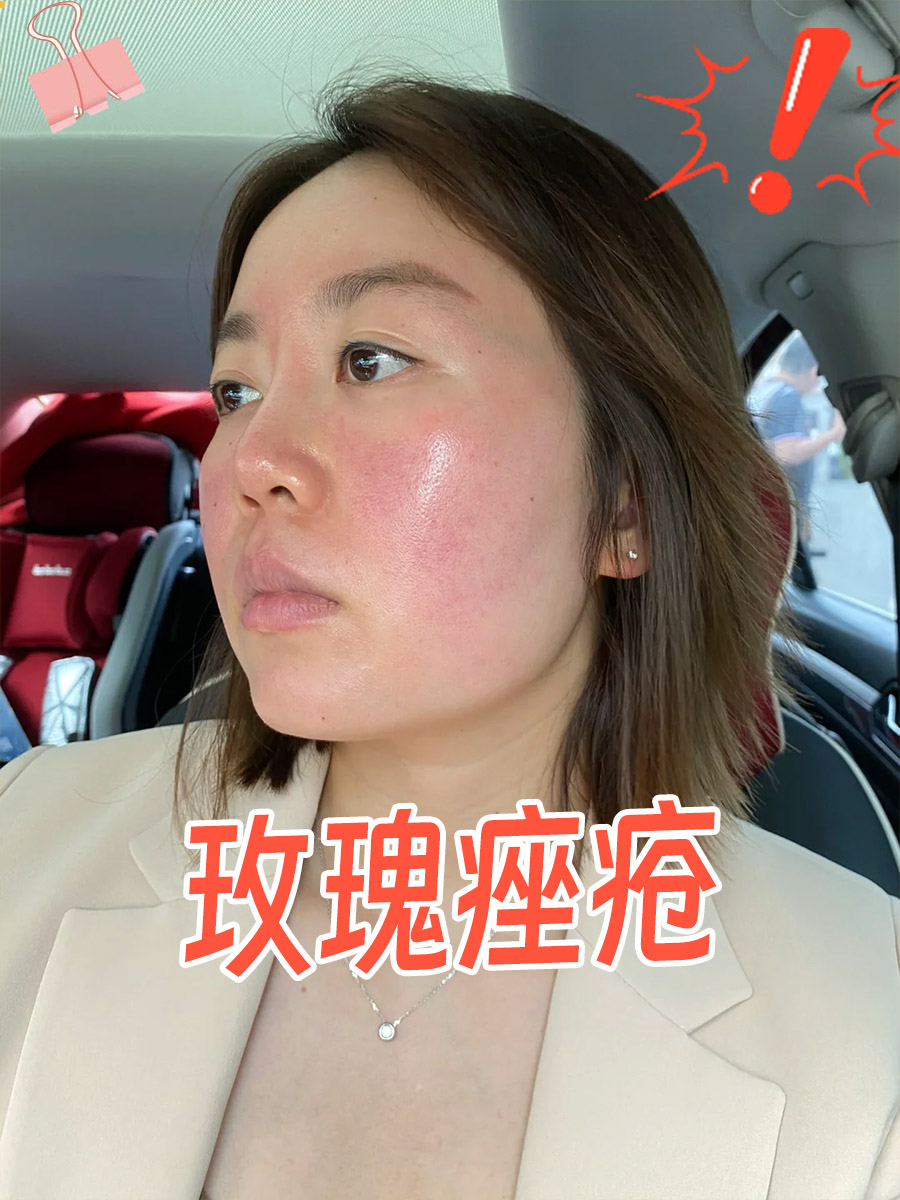 玫瑰痤疮的4种类型，快来看看你是属于哪一种