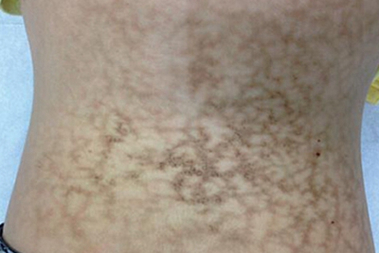 网状色素失禁症腰部症状图