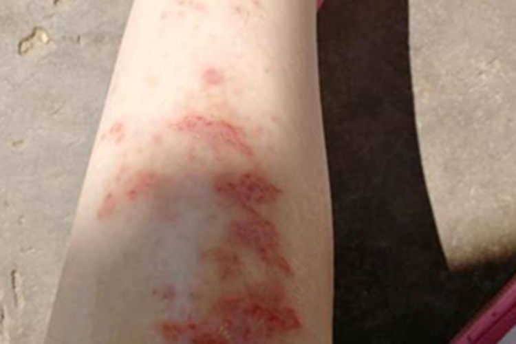 亚急性湿疹小腿一片片红斑图 亚急性湿疹小腿一片片红斑图