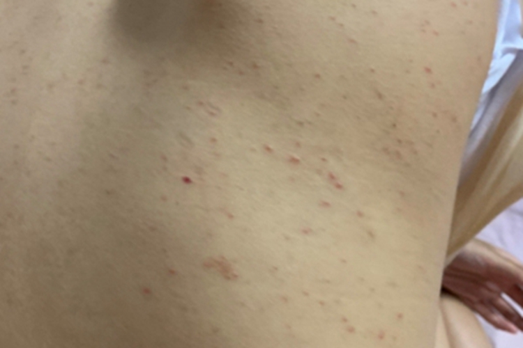 毛囊炎背部很多丘疹图