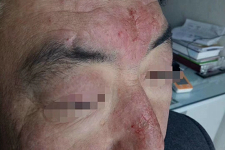 过敏性皮炎面部结痂图