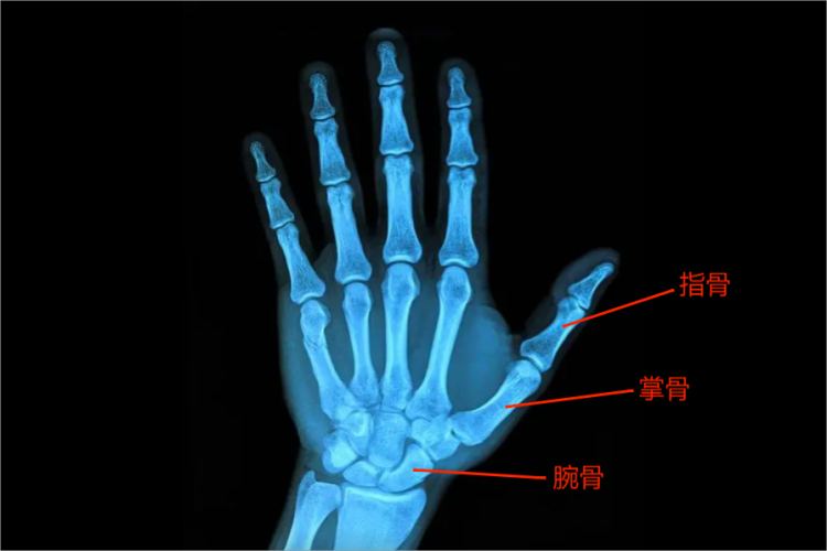 左手CT图 左手CT图