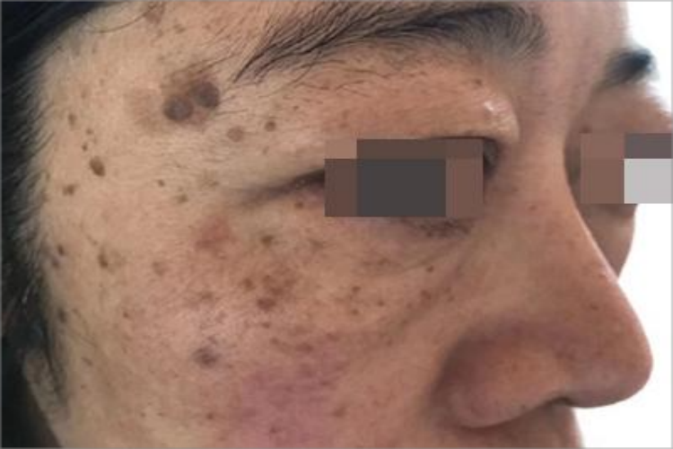 疣状脂溢性角化症面部症状图