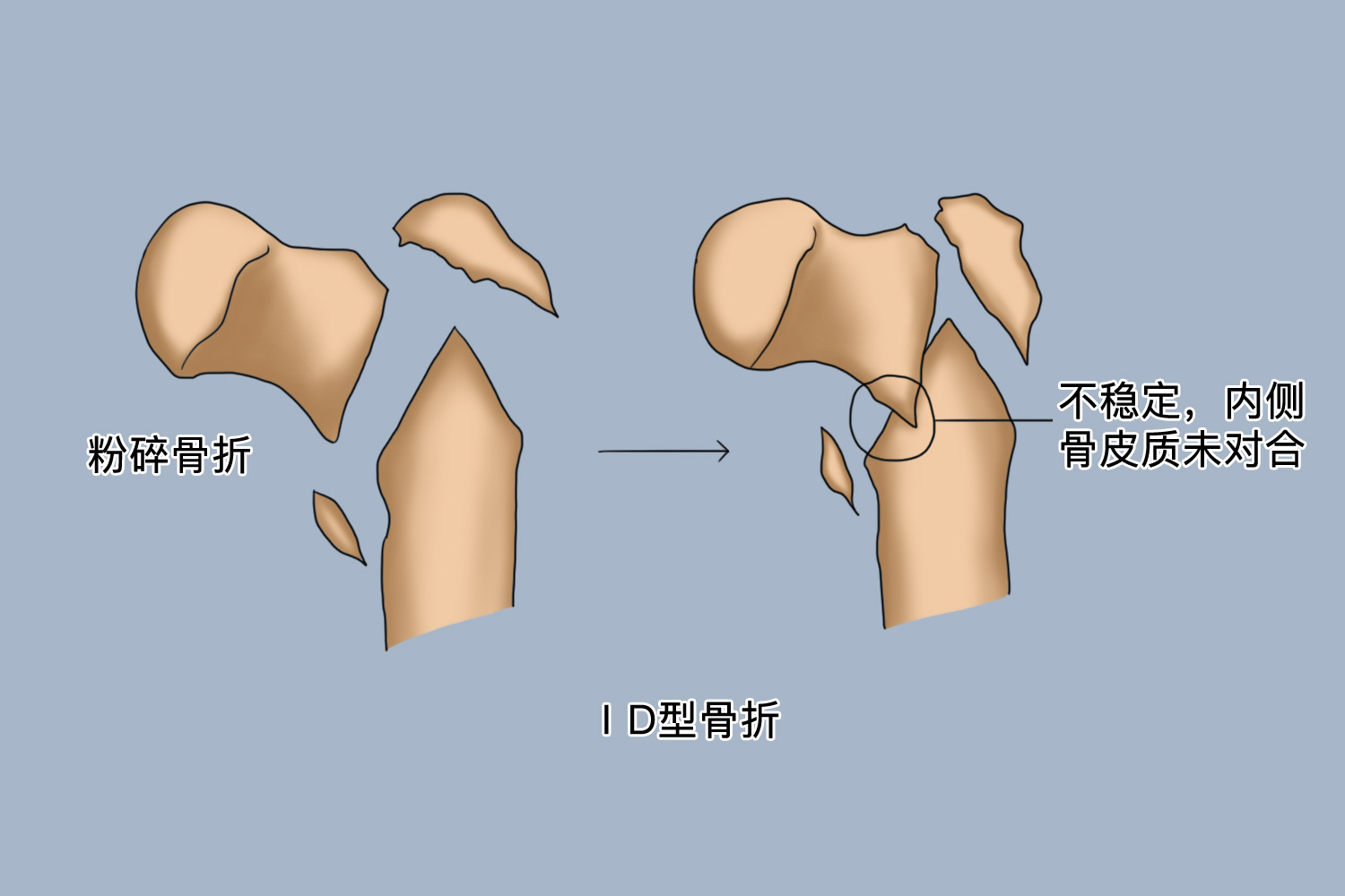 EvansⅠD型骨折图