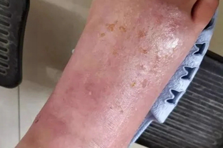 急性接触性皮炎脚背红肿图 急性接触性皮炎脚背红肿图