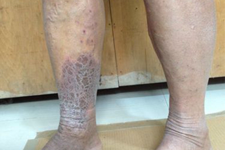 淤积性皮炎黑斑图