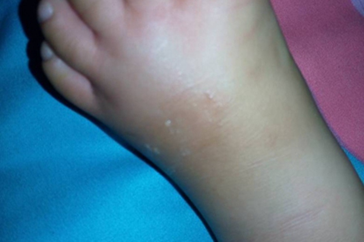 维生素E缺乏症水肿图