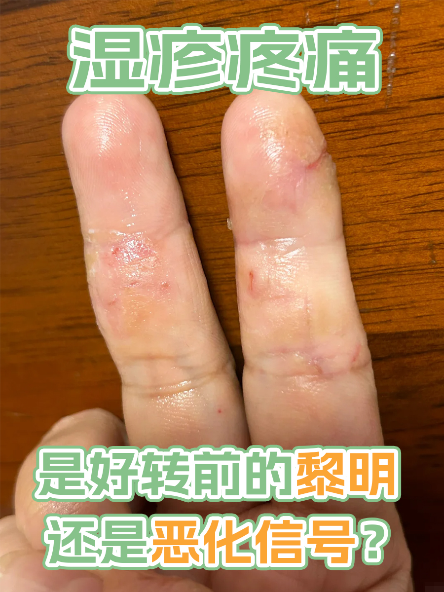 湿疹疼痛，是好转前的黎明还是恶化信号？