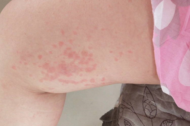 早发型妊娠痒疹大腿丘疹图 早发型妊娠痒疹大腿丘疹图