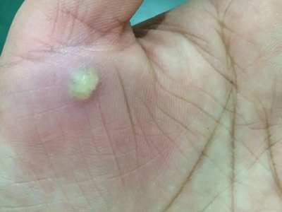 皮肤钙质沉着症的症状和图片 - 有来医生