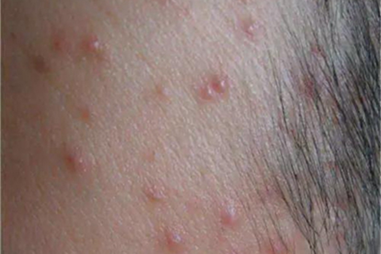 嗜酸性脓疱性毛囊炎颞部症状图 嗜酸性脓疱性毛囊炎颞部症状图