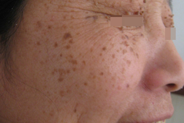 寻常疣眼周有很多小肉赘图