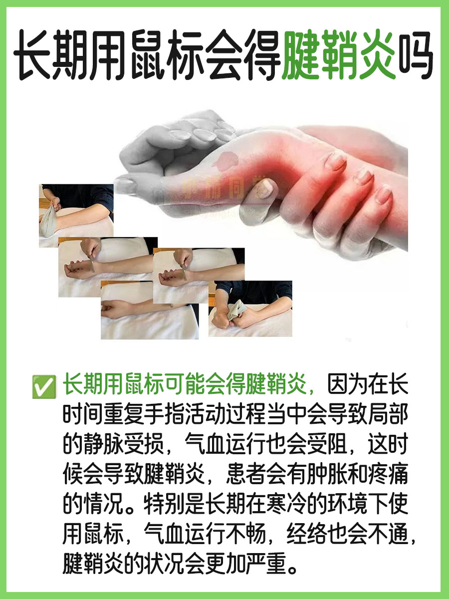 医生分享：长期握鼠标的你，是否已步入腱鞘炎陷阱？