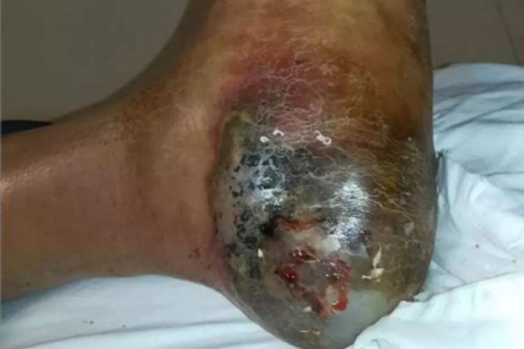 蛇咬伤脚后跟坏死图