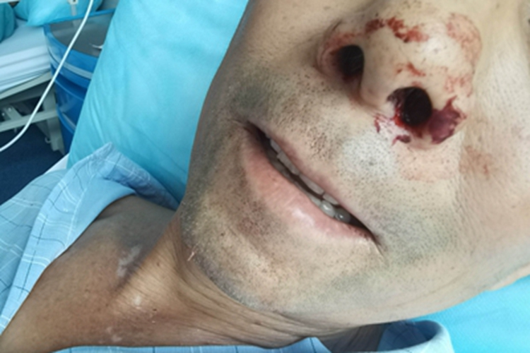 鼻咽癌鼻腔症状图