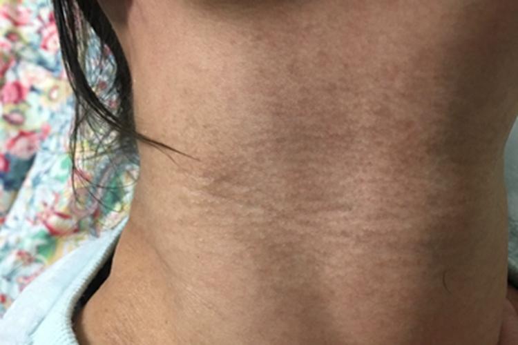 网状肢端色素沉着前颈皮肤发黑图