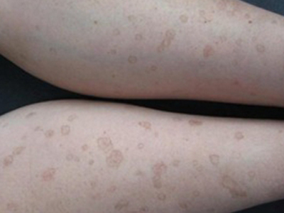 汗孔角化症小腿上有好多褐斑图.jpg