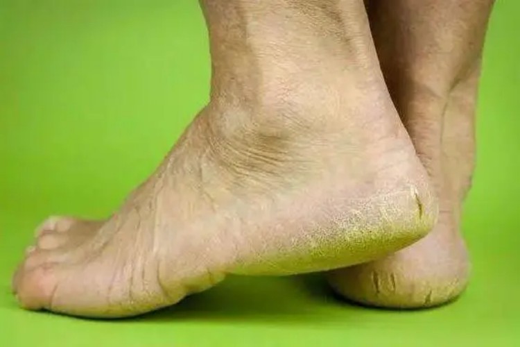 老年性皮肤萎缩脚部皮肤粗糙图